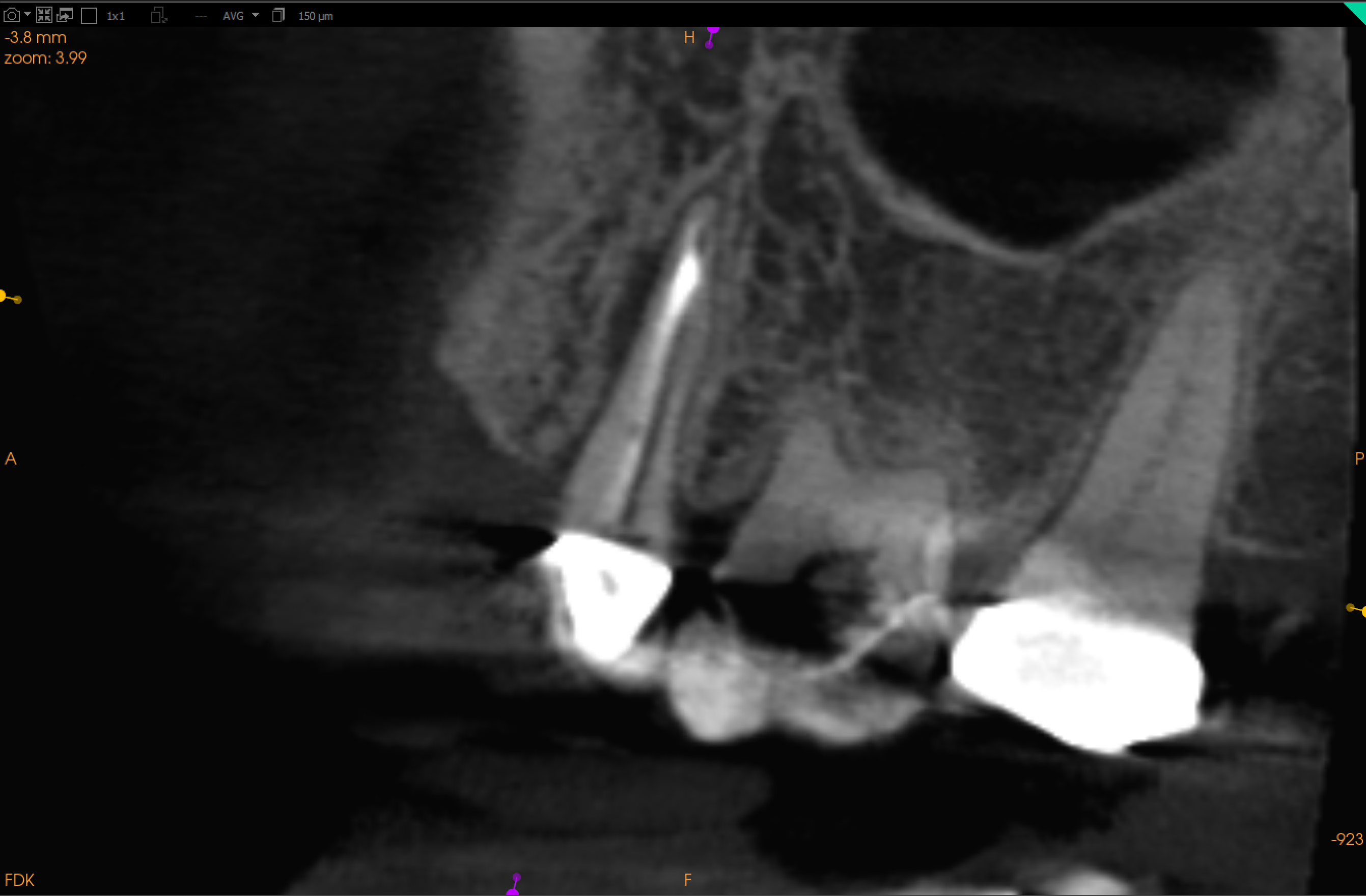 Beam hardening artifact