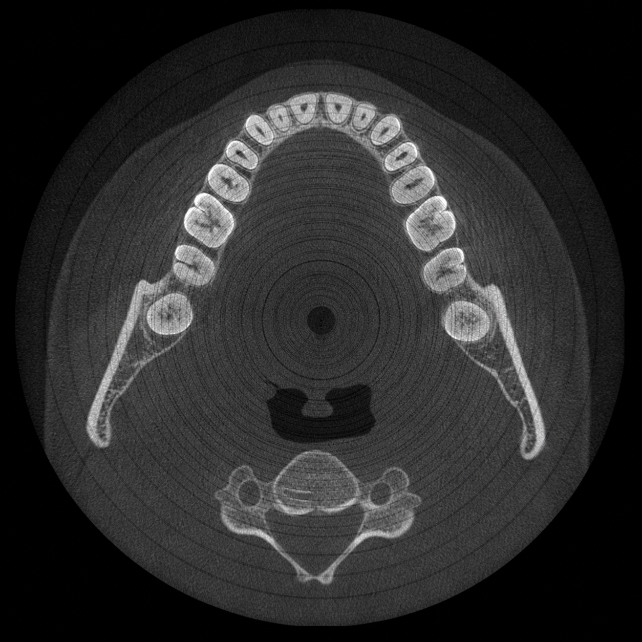 Ring detector artifact